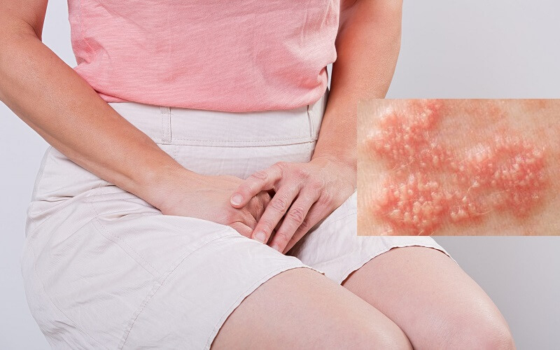Bệnh sùi mào gà có nguy hiểm không?