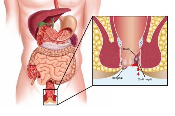 Bệnh trĩ và cách chữa trị hiệu quả nhất